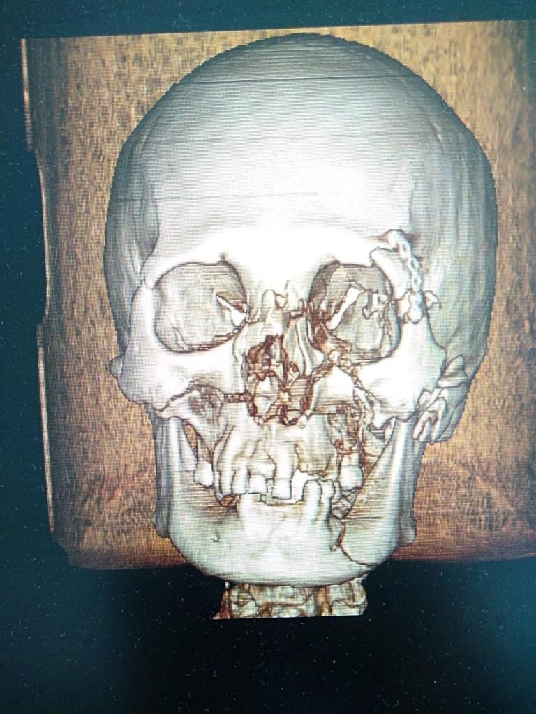 Врачи из Башкирии реконструировали лицо пациенту