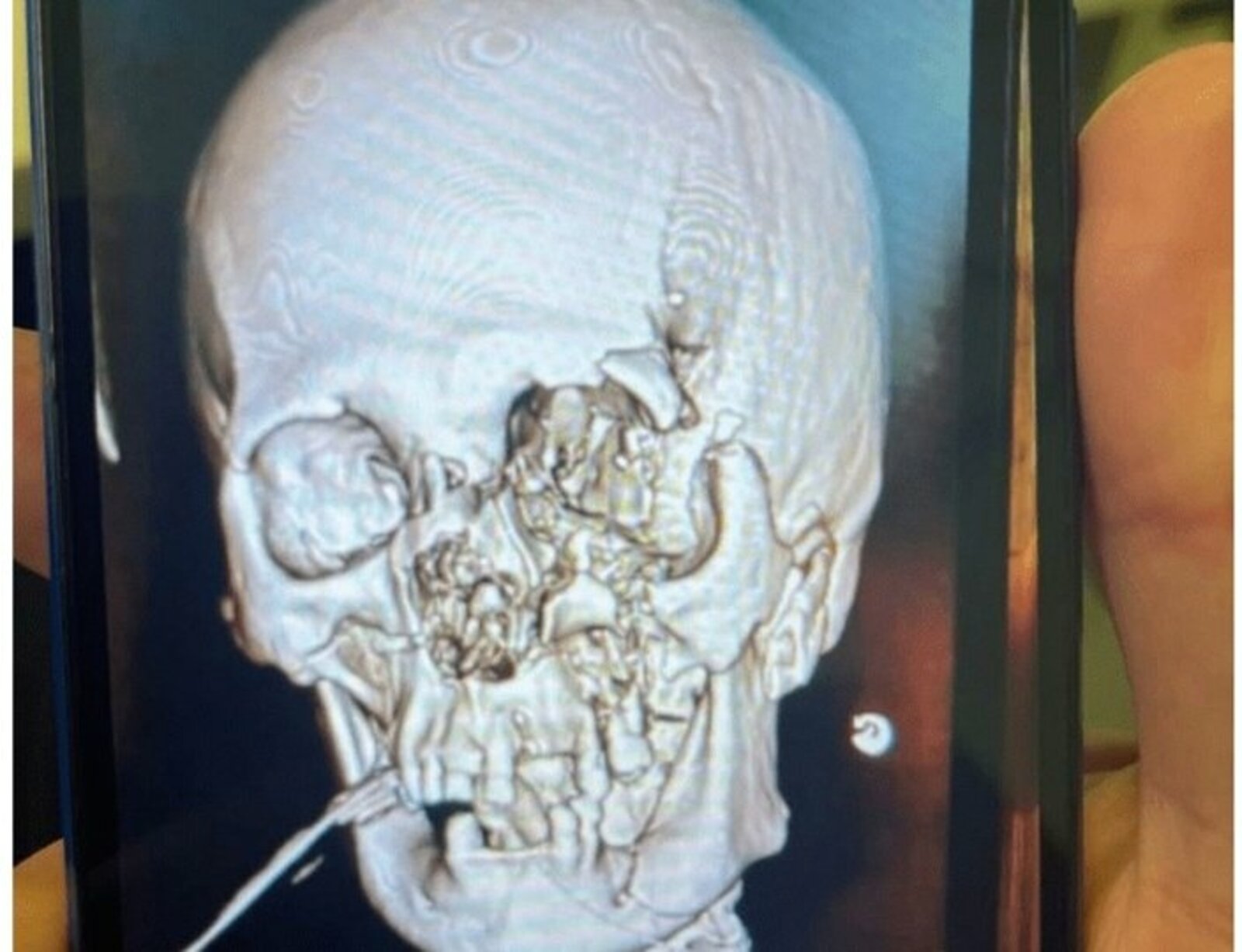 В уфимской больнице пациентке реконструировали лицо